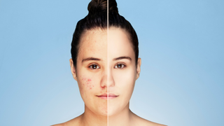 Is Castor Oil Good for Pimples or Not?